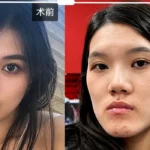 Foto Operasi rahang gagal wajah berubah drastis