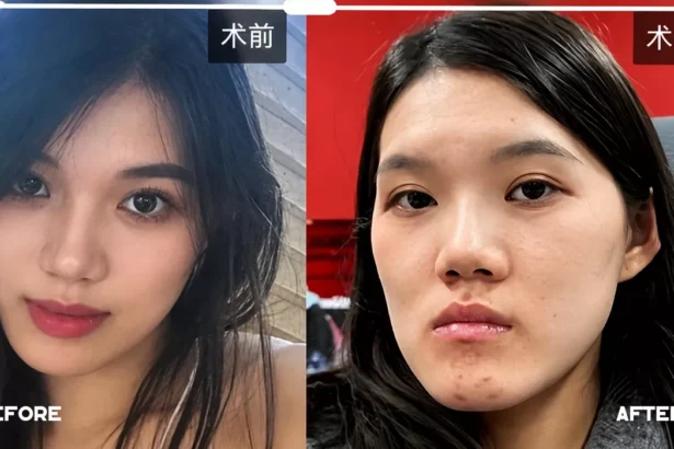 Foto Operasi rahang gagal wajah berubah drastis